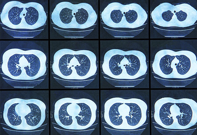 【肺部CT】認識詳細步驟！進行前後要注意甚麼？