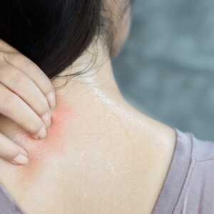 【汗疹】即睇原因、治療及預防方法