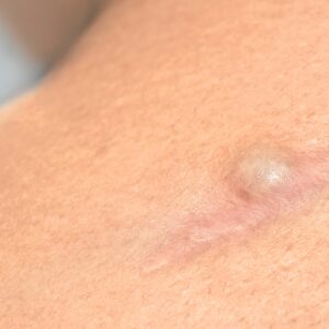 【粉瘤】會發炎嗎？即睇成因、初期症狀、治療及預防方法