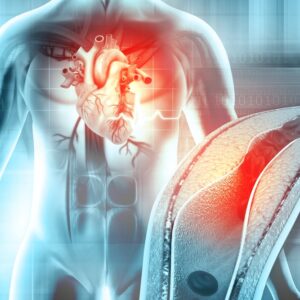 【心血管阻塞】成因、症狀、檢查、治療方法與保險理賠