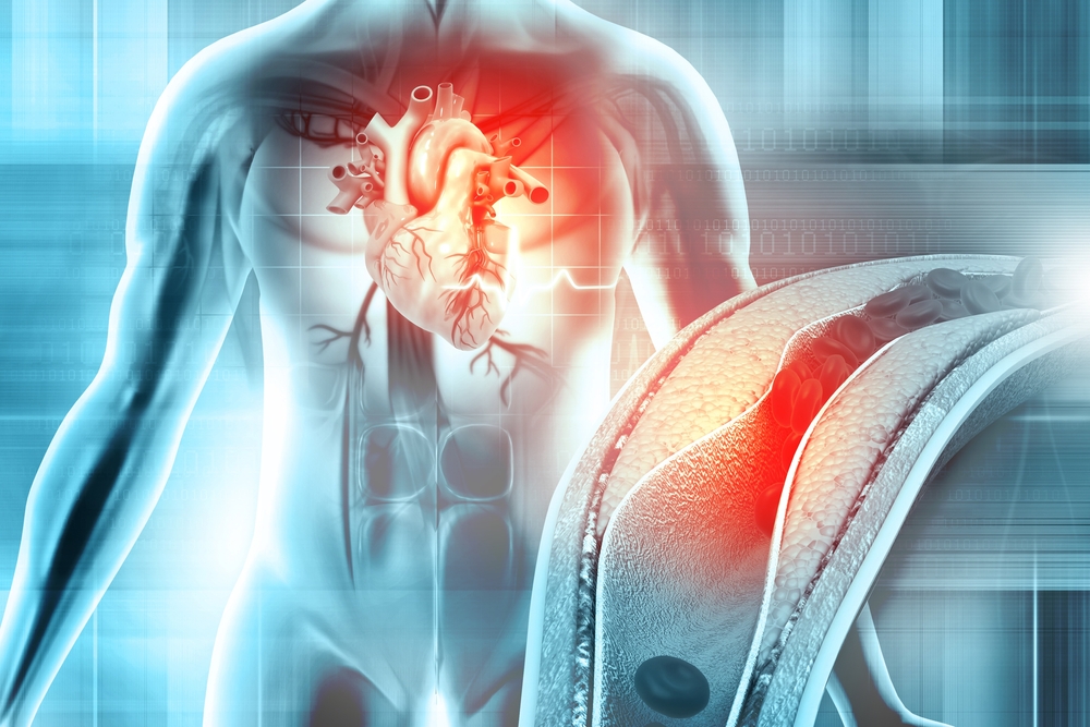 【心血管阻塞】成因、症狀、檢查、治療方法與保險理賠