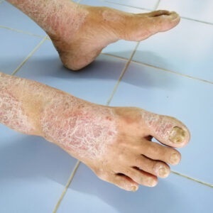 【硬皮症】了解初期症狀、飲食須知、壽命及保險保障（附照片）