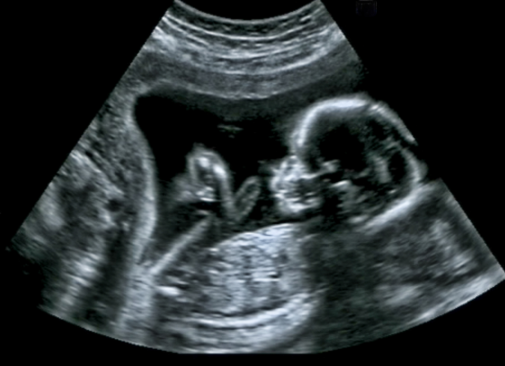 Fetal Morphology Scan in Hong Kong: Everything you need to know