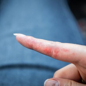 【汗皰疹】了解症狀、形成原因、治療、與香港腳的分別