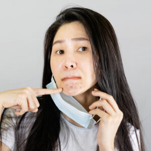 【暗瘡】了解種類、症狀、位置、成因、治療與預防