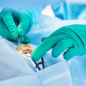 【玻璃體切除術】了解後遺症、術後護理、費用及保險索償