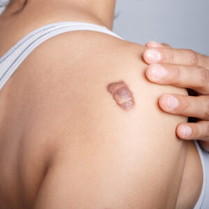 【蟹足腫】是什麼？成因和消除方法有哪些？（附治療價錢參考）