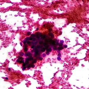 癌症有幾多種？認識5大常見種類