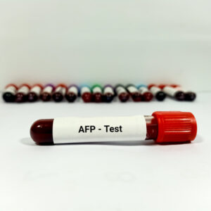 【甲胎蛋白】指數升高反映什麼？如何解讀？