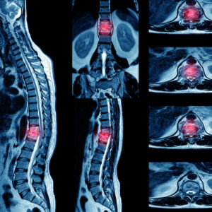 【癌症擴散】了解轉移性癌症的常見症狀及存活率