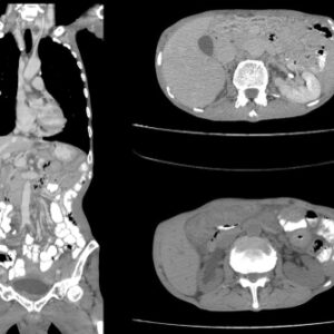 腹部電腦掃描（CT Scan）2025：用處、檢查過程與收費