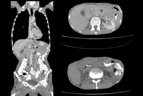 腹部電腦掃描（CT Scan）2025：用處、檢查過程與收費