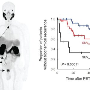 【中西醫說】前列腺癌手術後 PSA 又上升，可以治療嗎？
