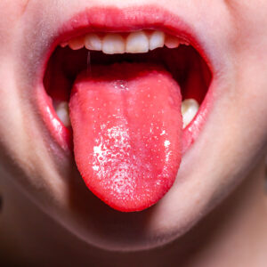 猩紅熱會傳染嗎？成因、症狀、治療及預防方法全面睇