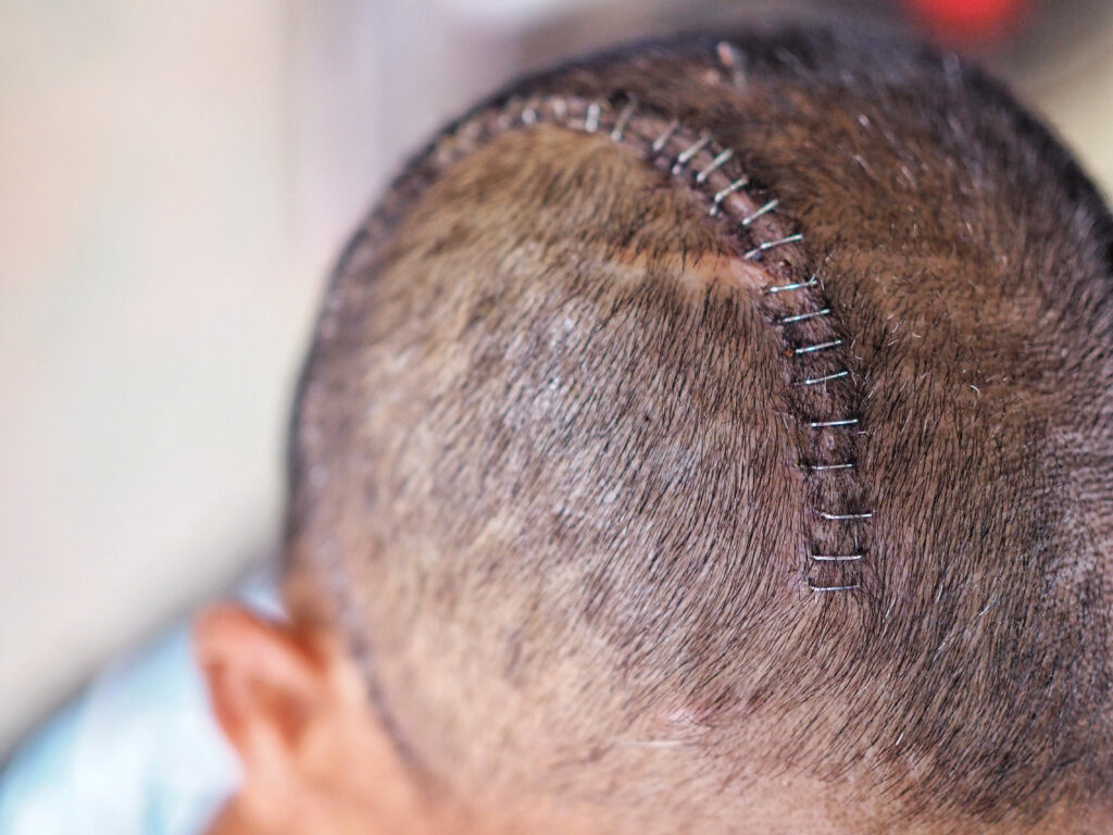 【開腦手術】有後遺症嗎？幾時要使做？手術種類、過程及恢復時間