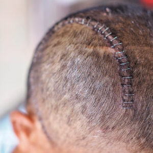 【開腦手術】有後遺症嗎？幾時要使做？手術種類、過程及恢復時間