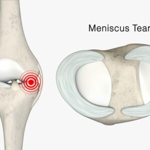 Torn Meniscus: Can You Still Get VHIS? Bowtie Underwriting Guide