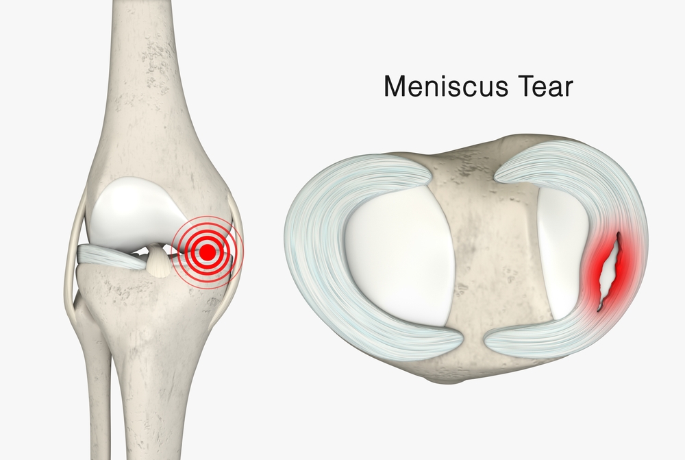 Torn Meniscus: Can You Still Get VHIS? Bowtie Underwriting Guide