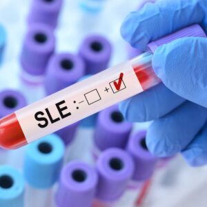 【系統性紅斑狼瘡】了解SLE成因、症狀、診斷及治療方法