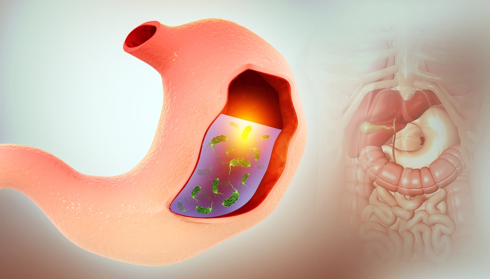幽門螺旋菌感染能自癒嗎？認識正確治療方法（附費用參考）