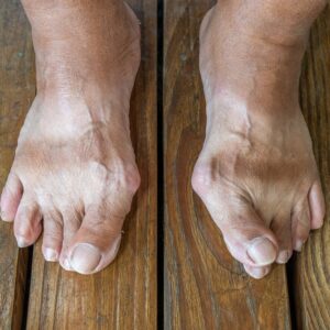 【拇趾外翻】矯正器有用嗎？了解成因、症狀、治療與預防方法