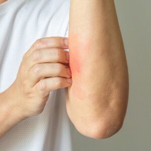 【金黃葡萄球菌】成因、症狀、感染途徑、治療及預防方法