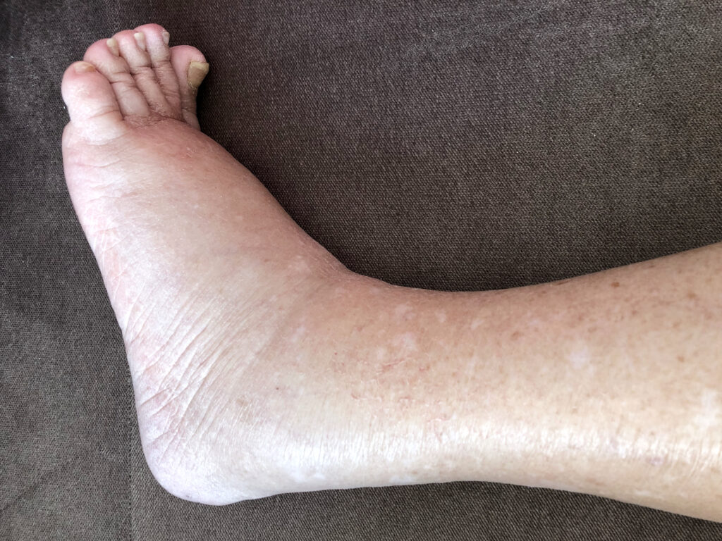 如何消除腳水腫？拆解水腫原因及消腫方法