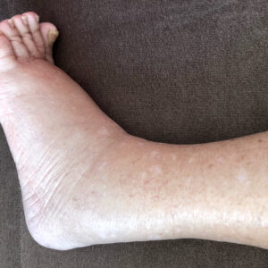 如何消除腳水腫？拆解水腫原因及消腫方法