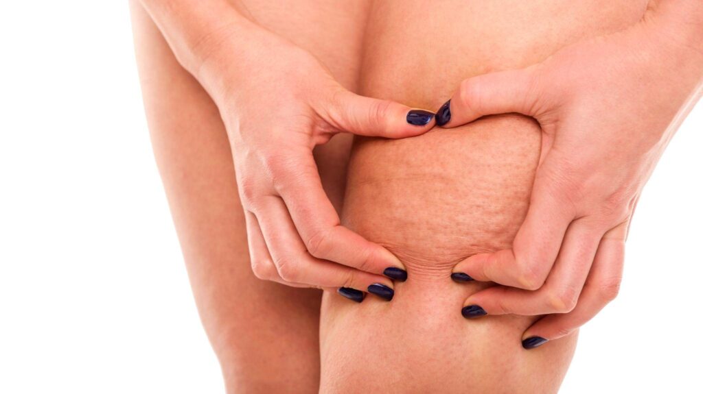 蜂窩組織炎檢查、治療費用幾錢？自願醫保包唔包？