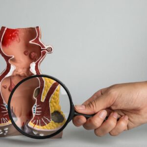 瘻管切除術費用幾錢？自願醫保包唔包？