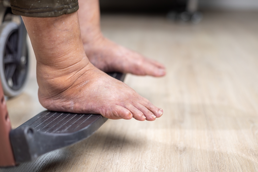 老人腳水腫：了解症狀、原因及紓緩方法