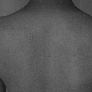 紅斑狼瘡檢查、治療費用幾錢？自願醫保包唔包？