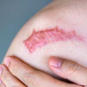 蟹足腫如何消除？成因、症狀及治療方法全攻略（附最新費用）