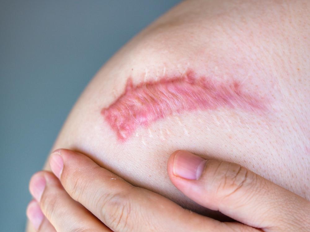 蟹足腫如何消除？成因、症狀及治療方法全攻略（附最新費用）